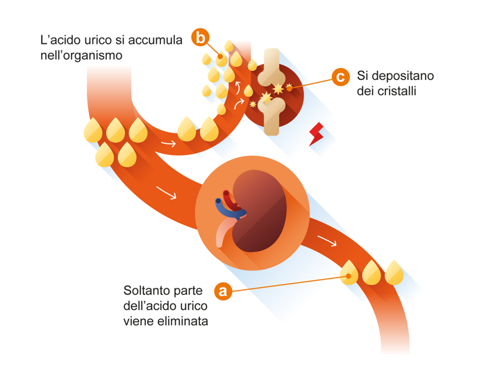 Soltanto parte dell acido urico viene eliminata